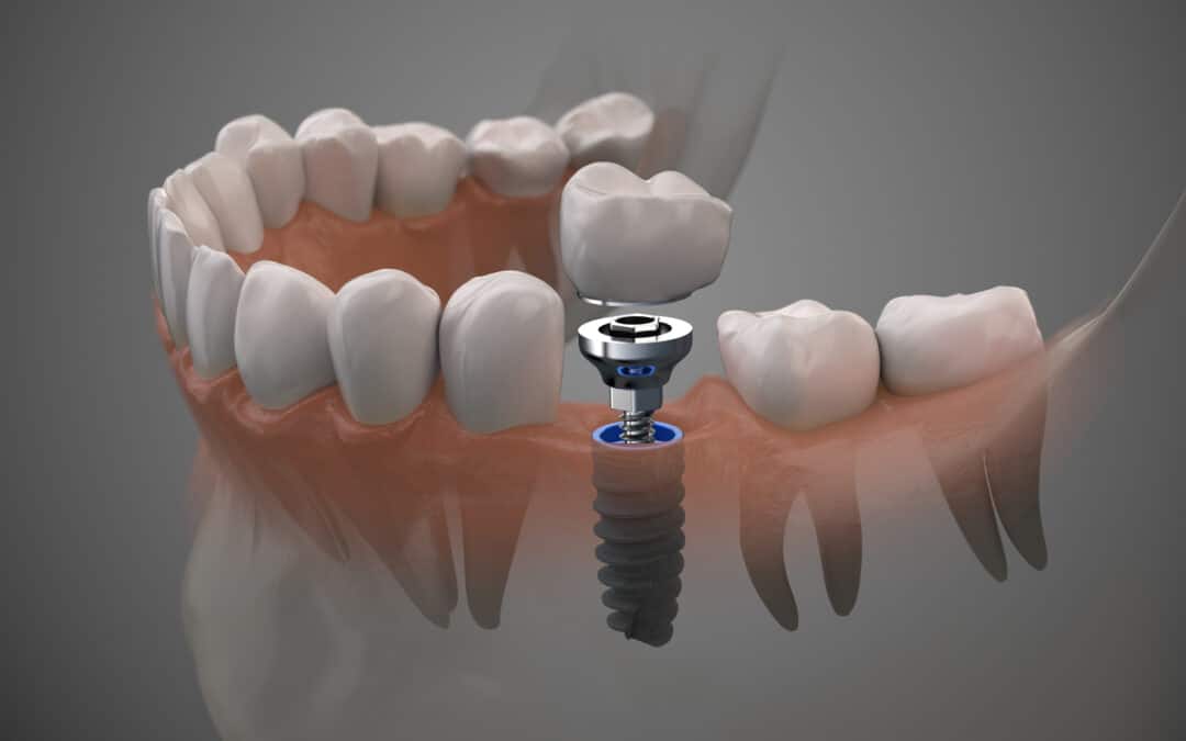 Tudo sobre o preço dos implantes dentários em Portugal