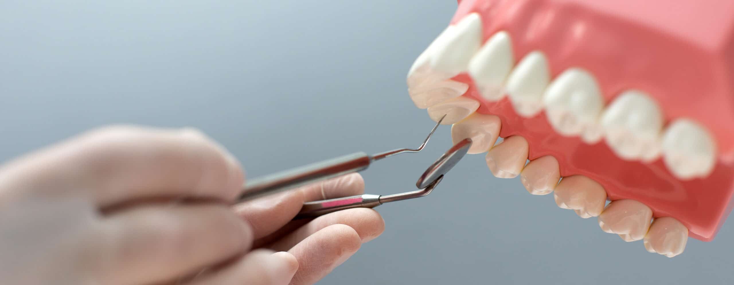 Modelo dentário utilizado na avaliação clínica