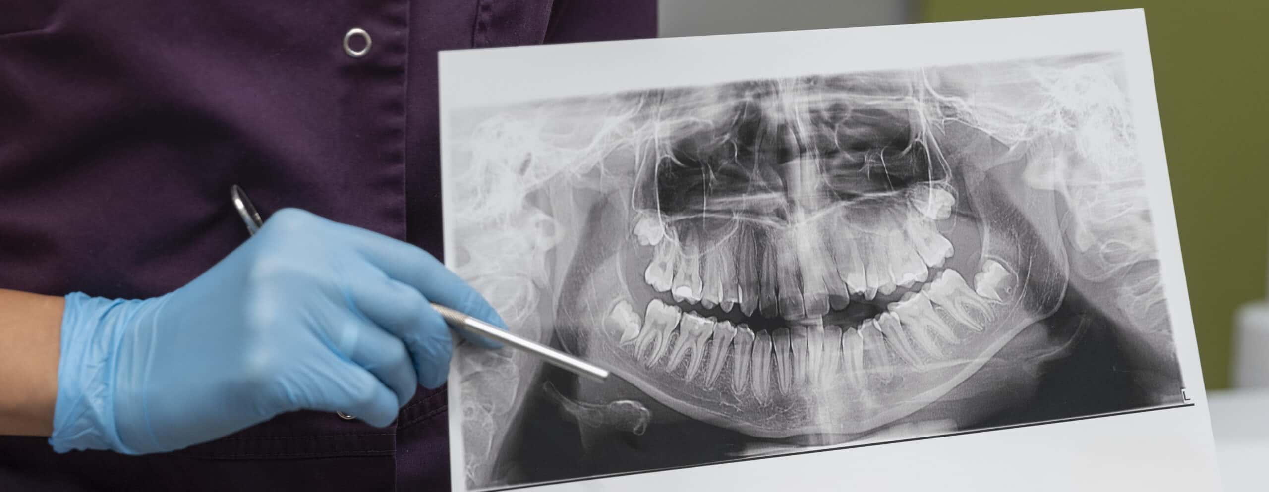 Análise de uma radiografia panorâmica dentária