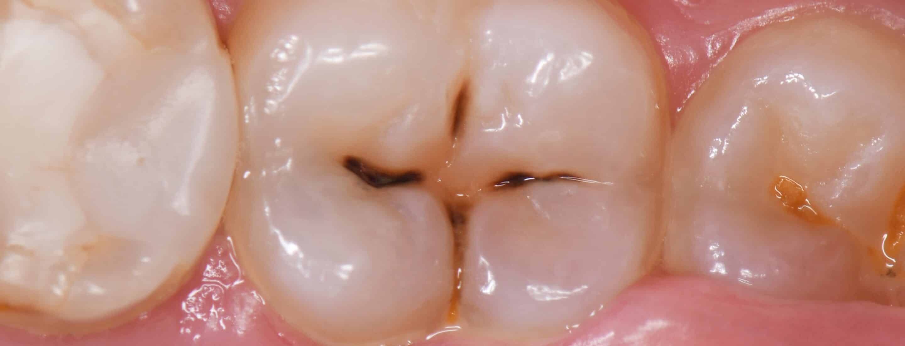 cáries nos dentes