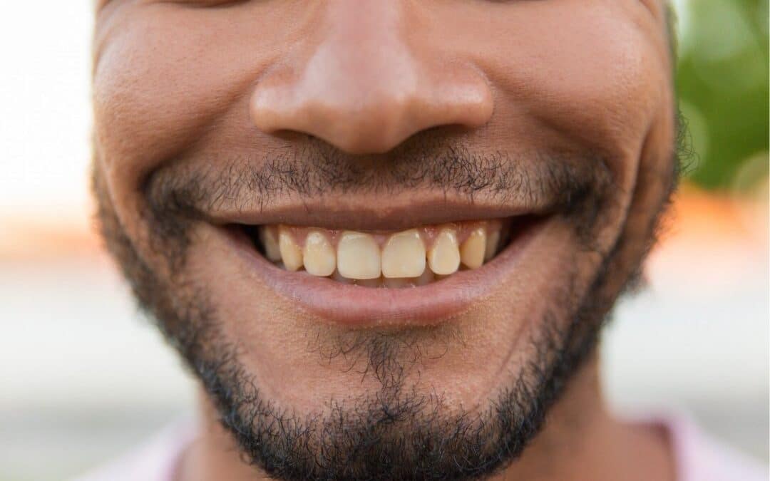 tartaro nos dentes