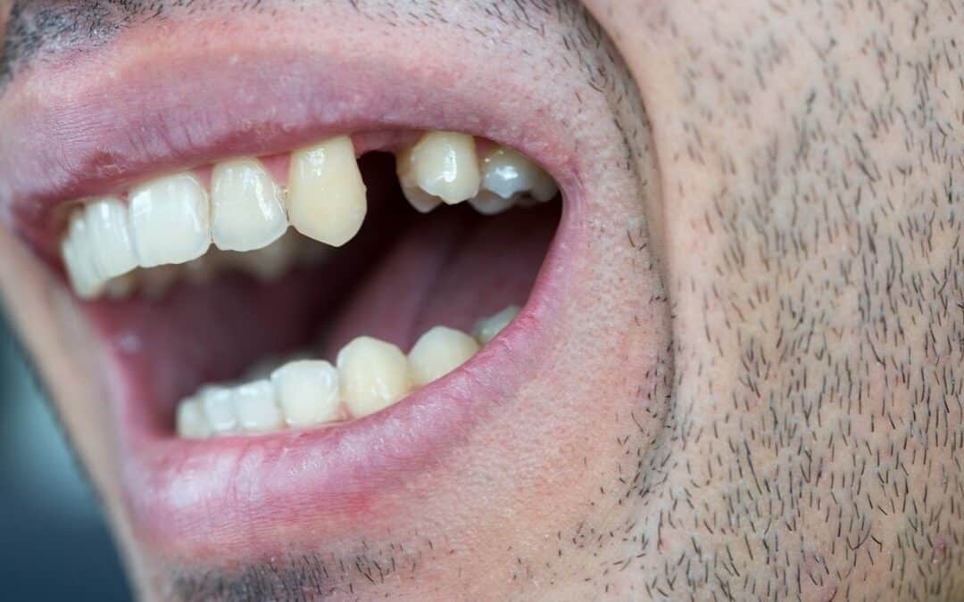dentes a abanar