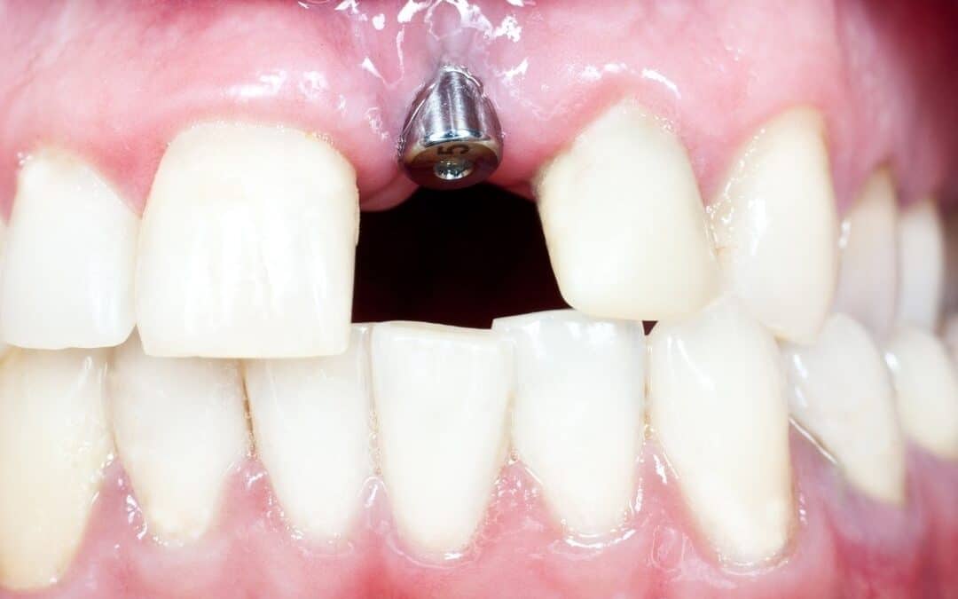 Implante com dente solto é grave? Veja aqui como resolver