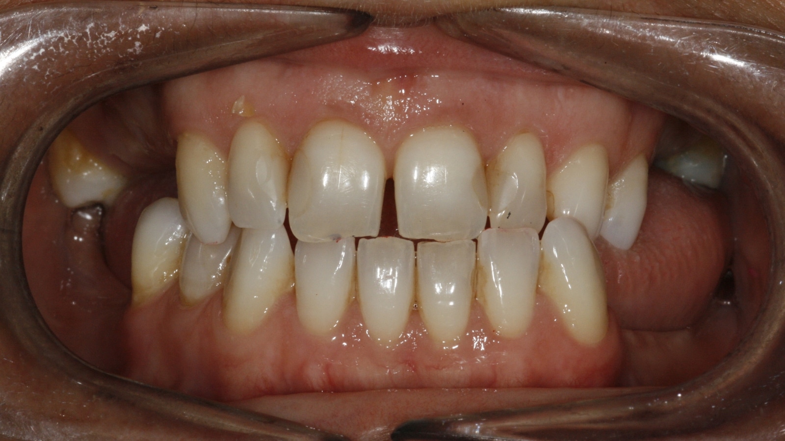 Implantes dentários — antes do tratamento