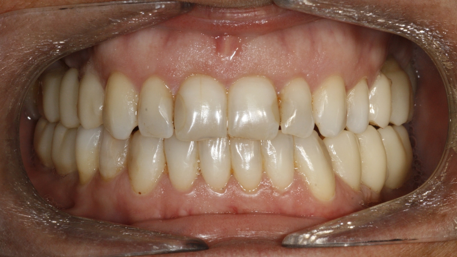 Implantes dentários — depois do tratamento
