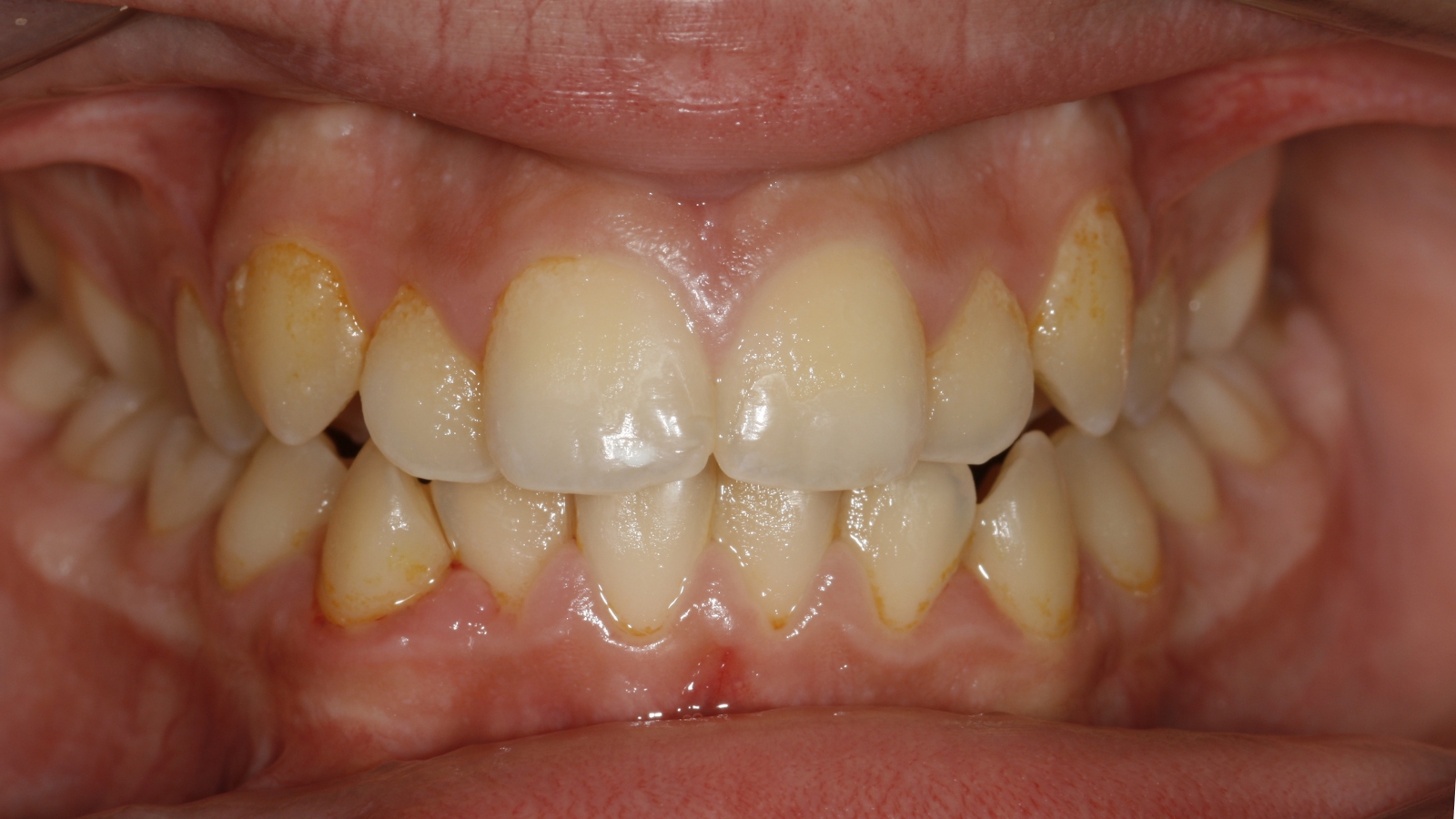 Invisalign — antes do tratamento