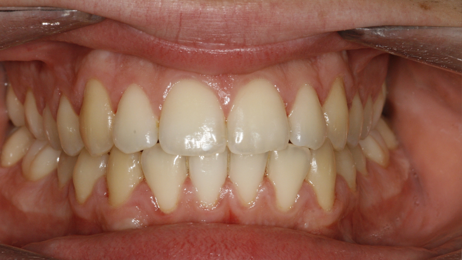 Invisalign — depois do tratamento
