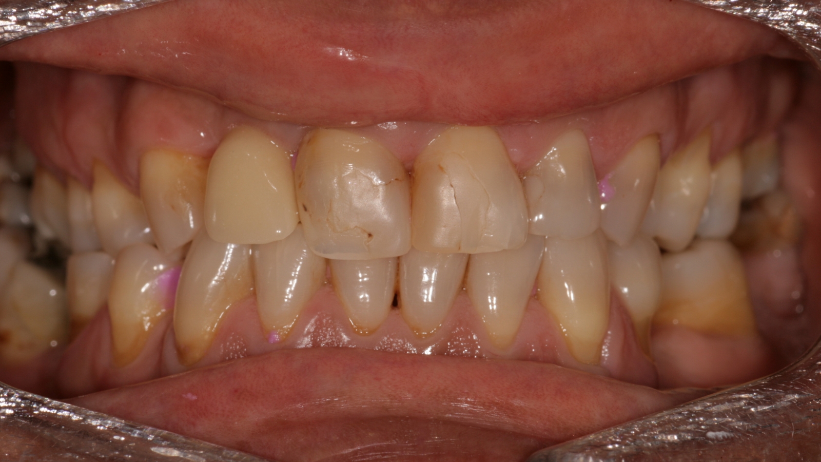 Facetas dentárias — antes do tratamento
