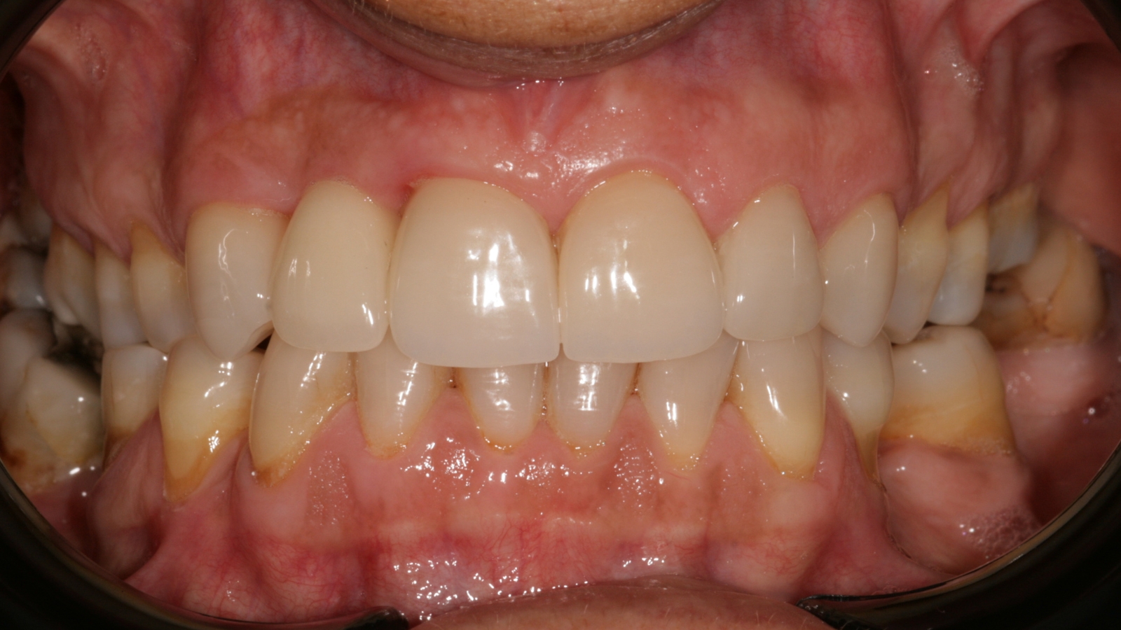 Facetas dentárias — depois do tratamento