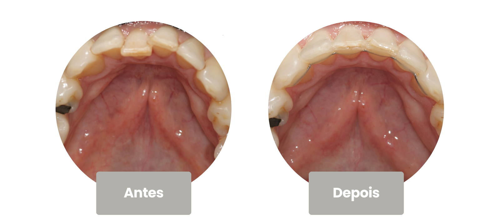 invisalign touch-up invisalign touch-up