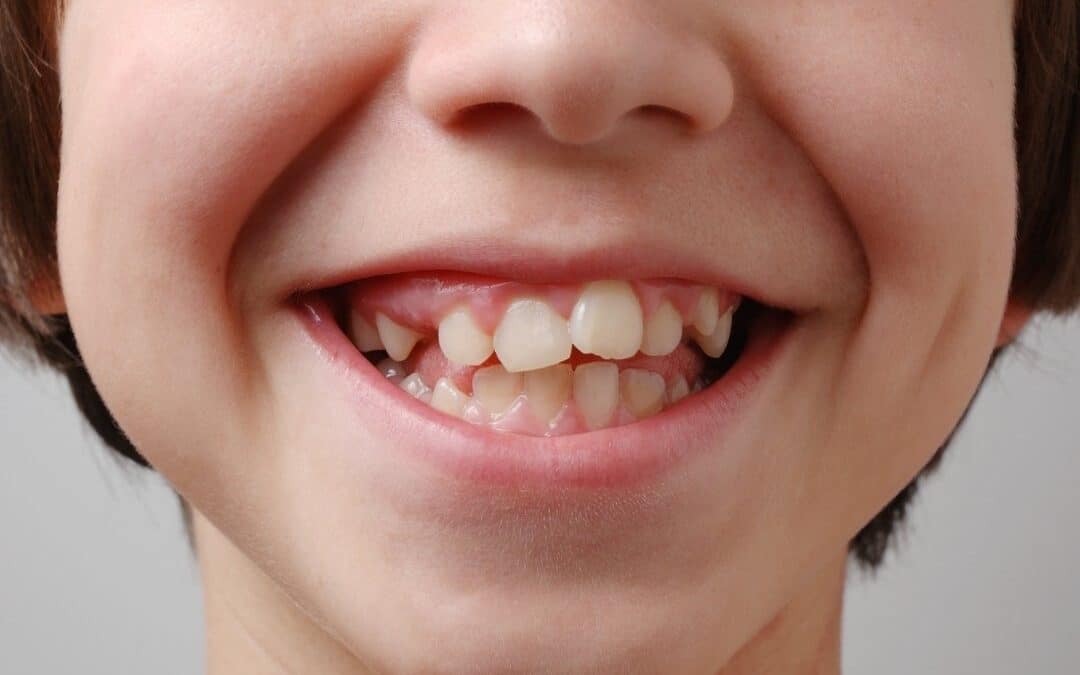dentes tortos