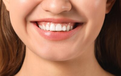 Gengivoplastia: o tratamento estético que transforma o seu sorriso