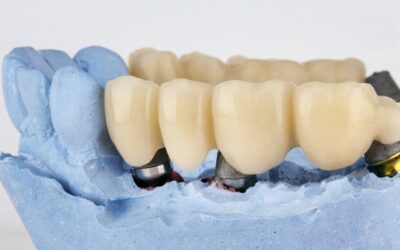Já ouviu falar em Ponte Dentária?