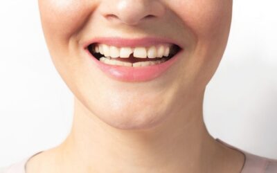 Melhores soluções para reconstruir dente partido