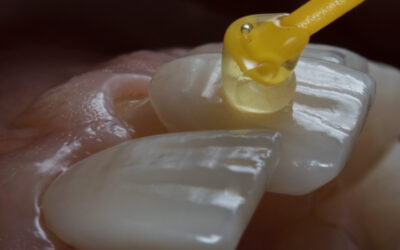 Facetas de resina: preço por dente, vantagens e tudo o que precisa de saber