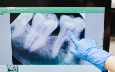 Desvitalizar um dente: tratamento endodôntico explicado por médicos dentistas
