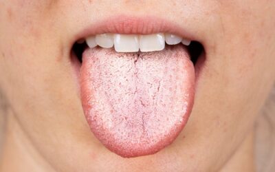 Língua Branca: o que significa e quando deve preocupar-se?