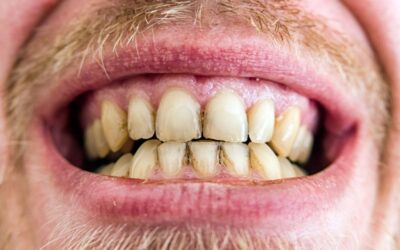 Placa bacteriana: o inimigo invisível que está a atacar os seus dentes