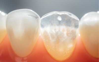 Dentes transparentes nas pontas: o que significa e como tratar?