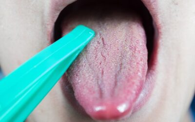 Xerostomia: porque sente a boca seca e o que pode fazer para aliviar
